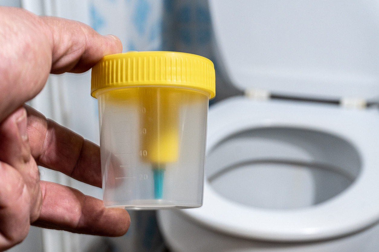 Dried urine sample on specialized filter paper